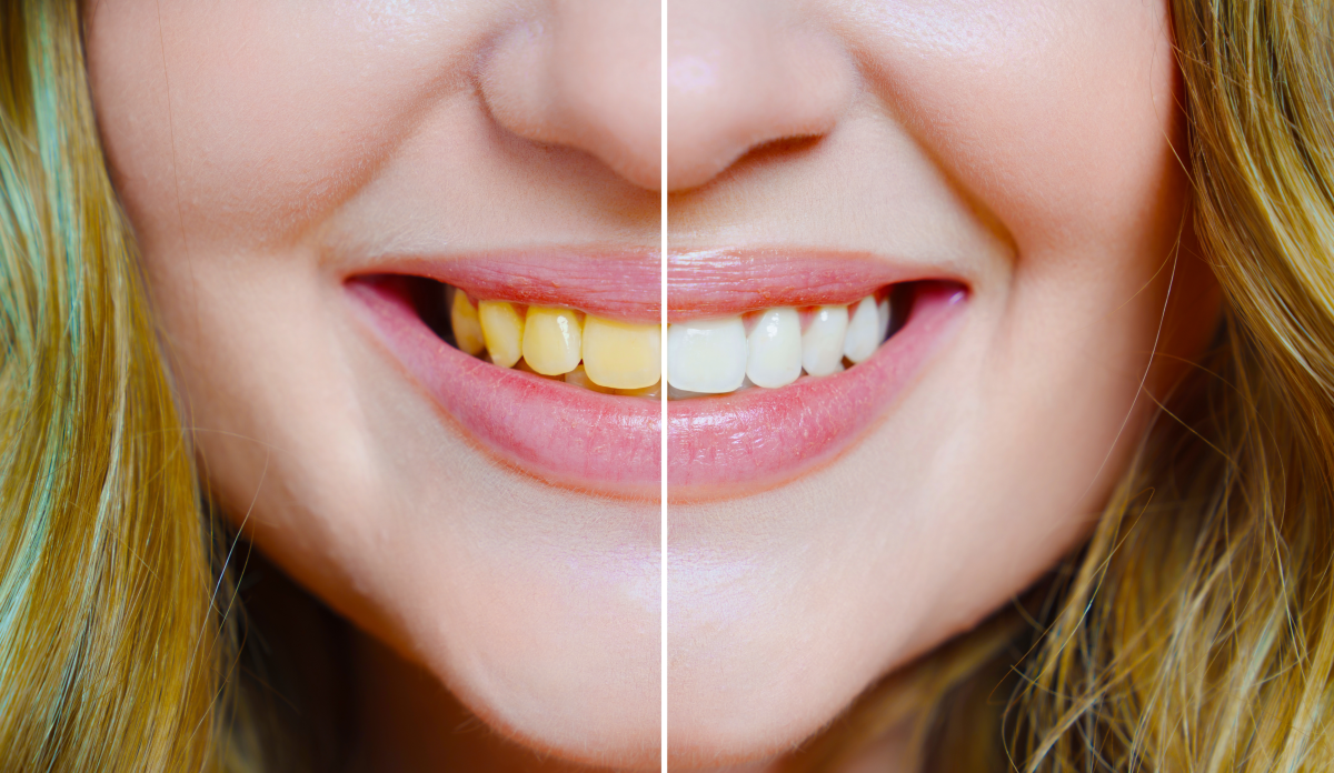 Veneers Cost Per Tooth How Much Should You Expect To Pay